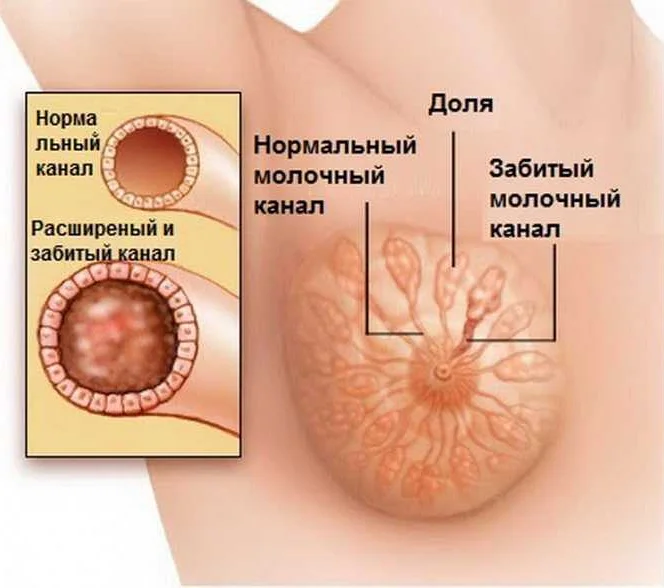 Капустный лист при лактостазе: как прикладывать компресс, отзывы