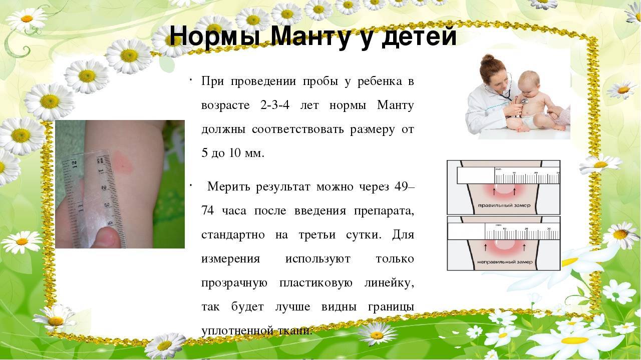 Реакция манту норма у детей и отклонения, фото, размеры