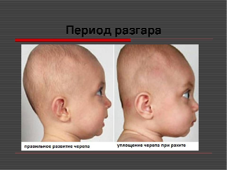 Формы рахита у детей. Рахит деформация черепа. Деформация головы при рахите. Изменение формы головы у новорожденного.