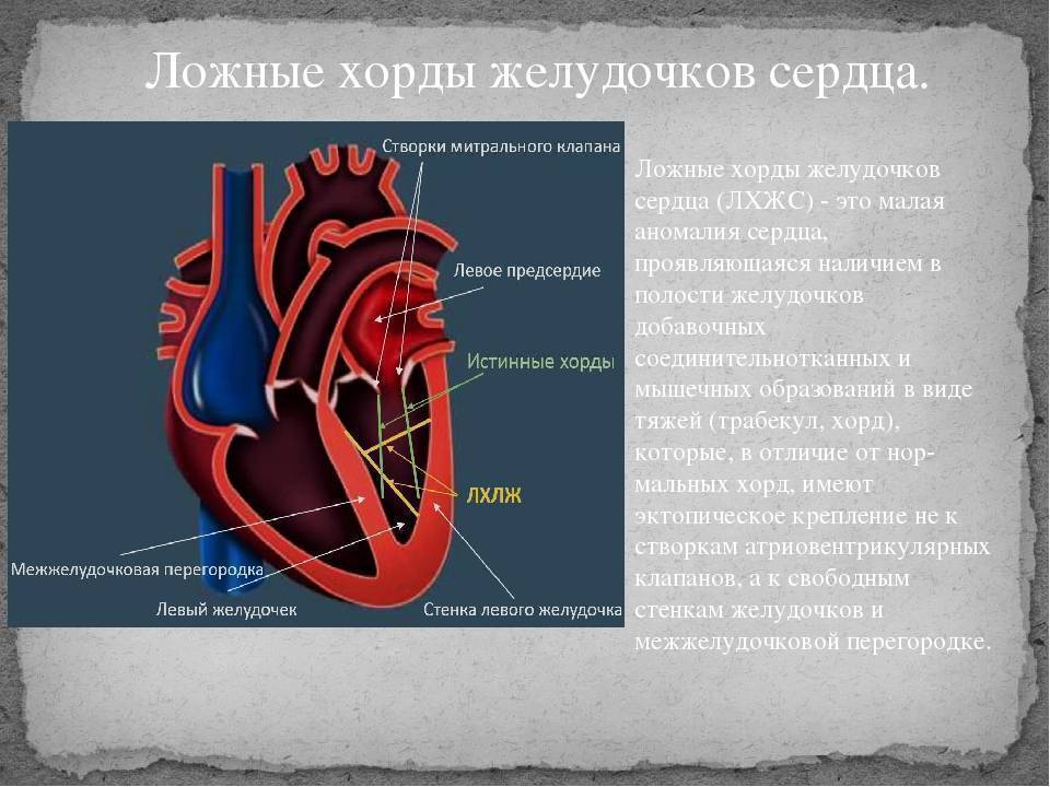 Дополнительная хорда в сердце: что это такое, причины, диагностика, лечение