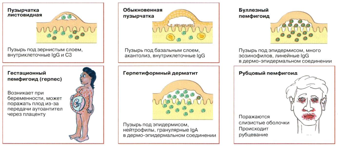 Волдыри у ребенка: на теле, лице, пальцах рук, ладошках! что это? пояснения с фото