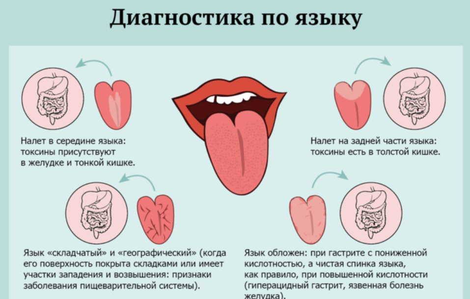 Белый налет на языке у малыша: причины, лечение заболеваний, сопутствующие симптомы