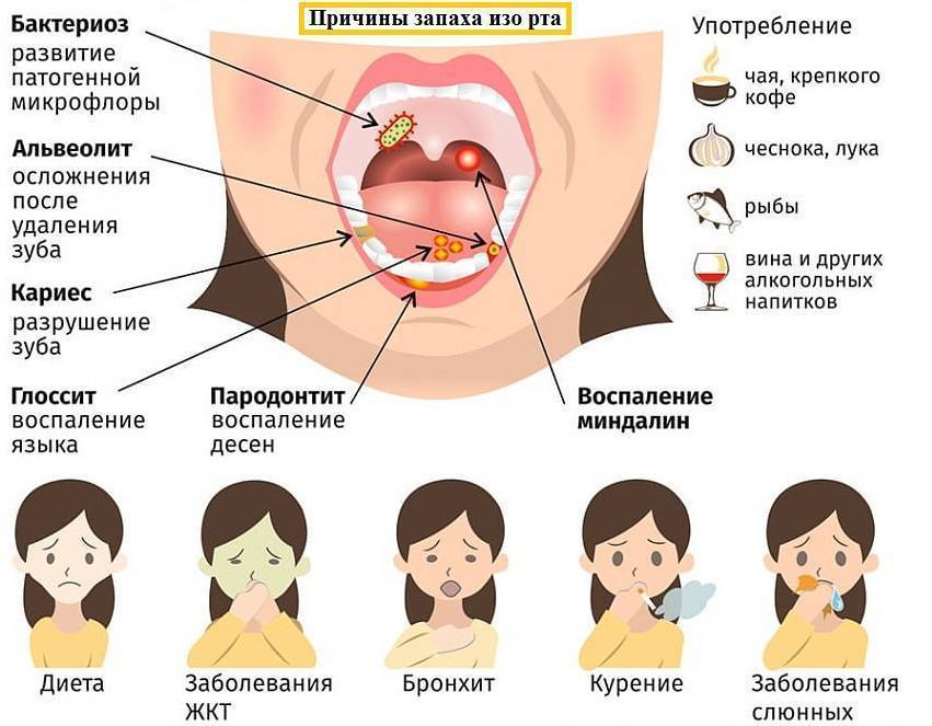 Причины и лечение запаха изо рта у грудничка