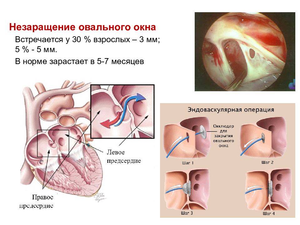 Открытый артериальный проток :: polismed.com
