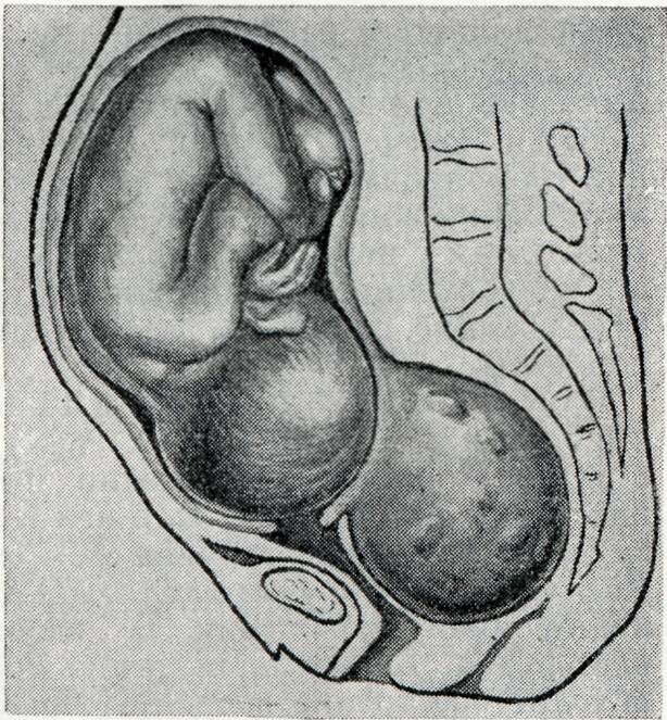 Миома матки у беременных • центр гинекологии в санкт-петербурге