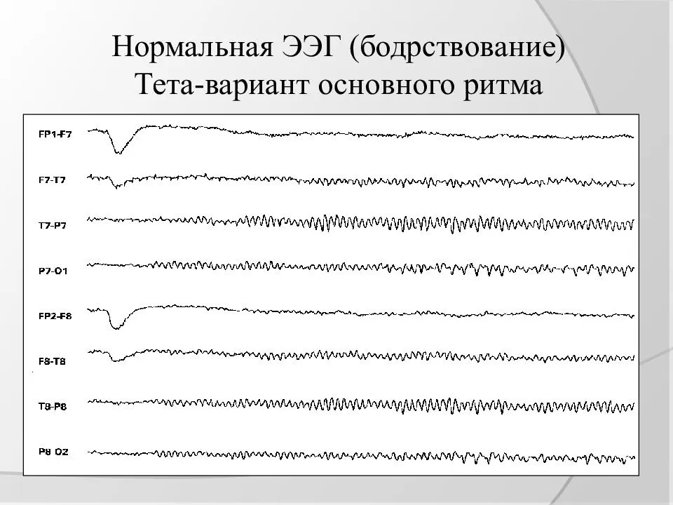 Ээг головы у взрослого. Расшифровка показателей электроэнцефалограммы ЭЭГ головного мозга. Ритмы ЭЭГ график. Эпилептиформные феномены на ЭЭГ что это. ЭЭГ волны.