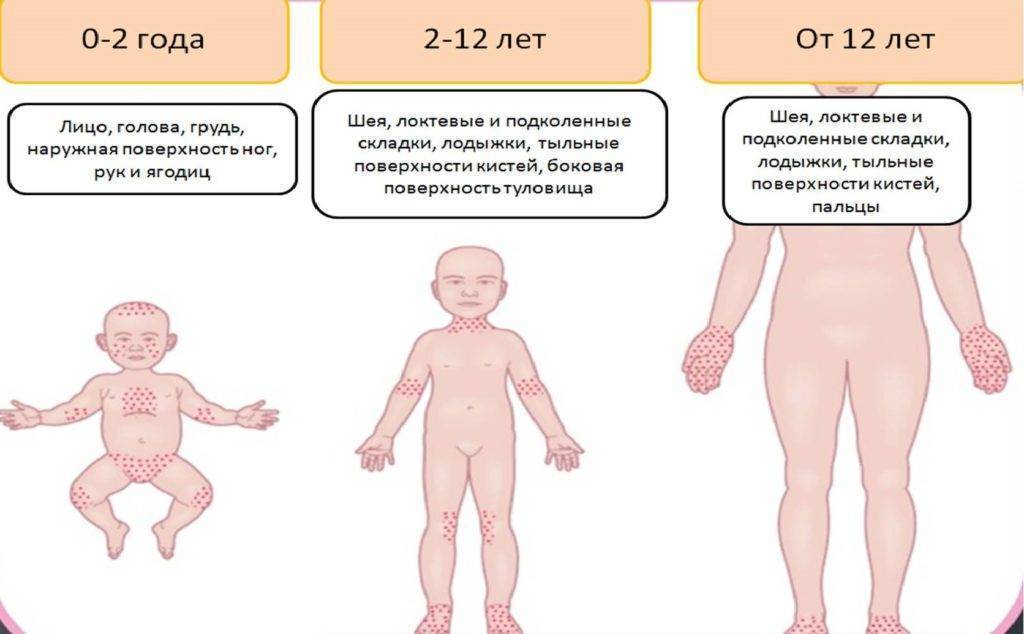 Лекарственная аллергия у детей - симптомы болезни, профилактика и лечение лекарственной аллергии у детей, причины заболевания и его диагностика на eurolab