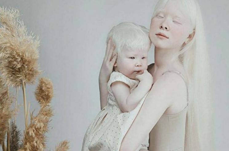 Кто такие альбиносы и почему. «белая ворона», или особенности здоровья и развития ребенка-альбиноса. передается ли по наследству альбинизм - все о строении человека
