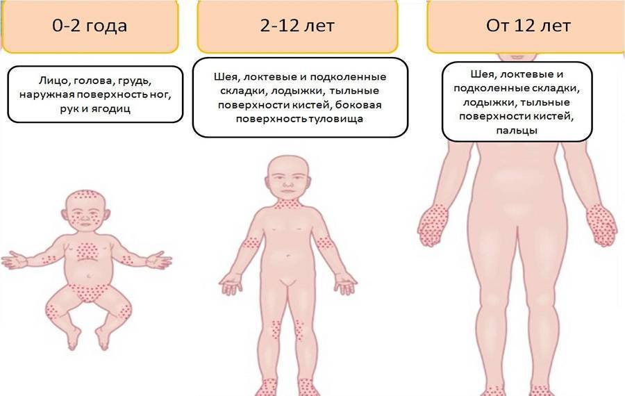 Потница у детей (7 фото): лечение, симптомы раздражения кожи