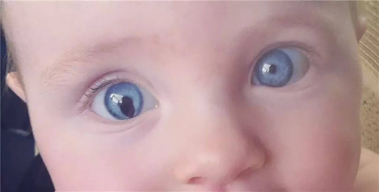 Глазки в 4 месяца. Колобома радужной оболочки глаза. Колобома сетчатки глаза. Гетерохромия и анизокория.