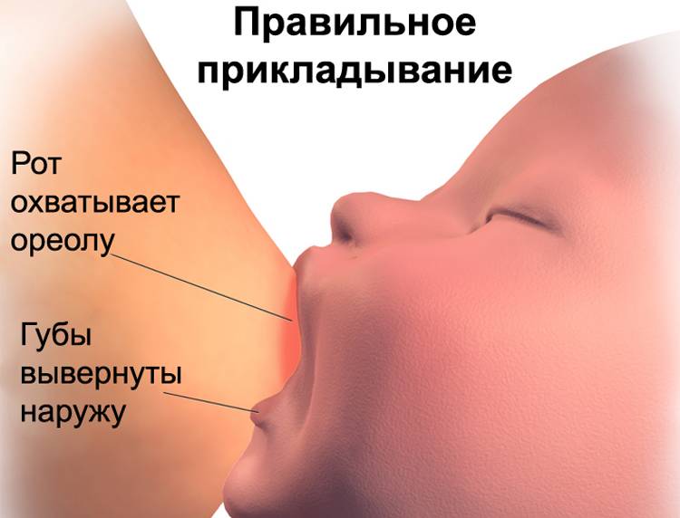 Трещины на сосках при кормлении: почему болит грудь, как быстро вылечить, фото