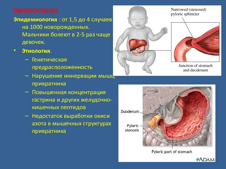 Кишечная непроходимость у новорожденных: симптомы, причины, лечение