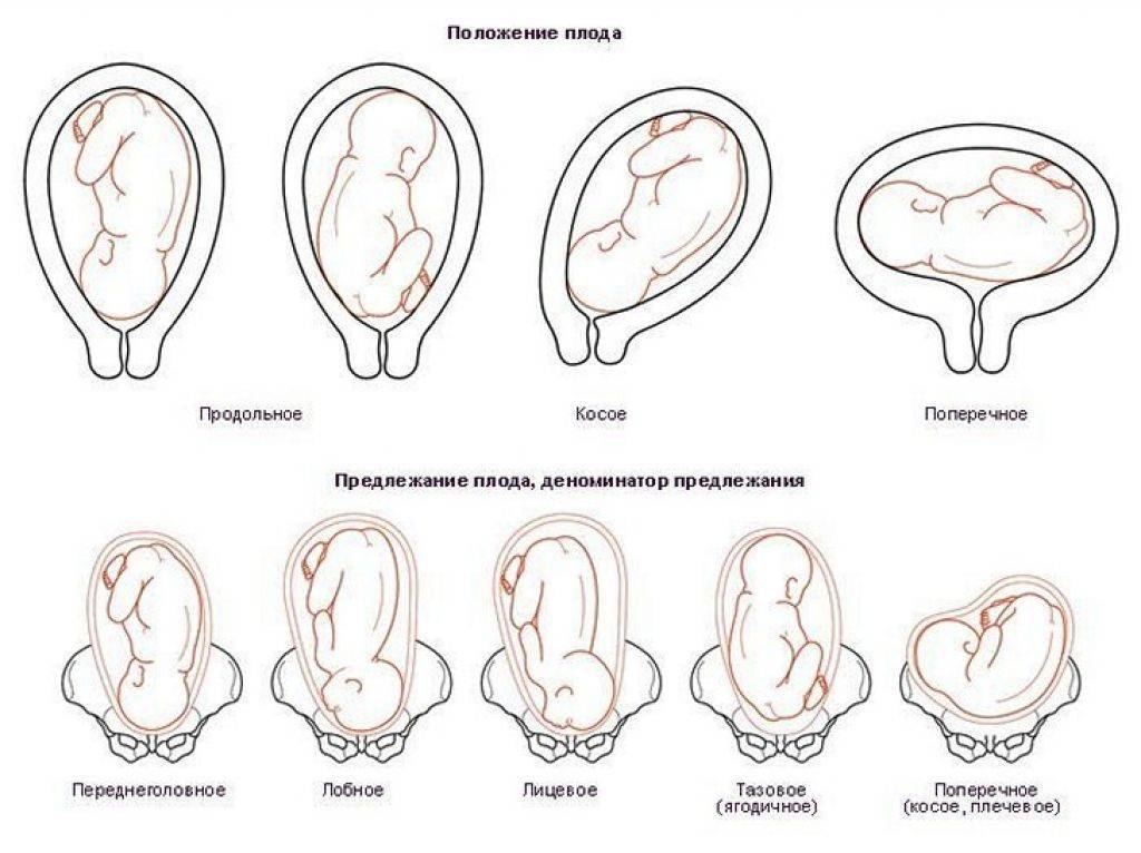 Тазовое предлежание плода: классификация, особенности, причины, ведение беременности и способы родов