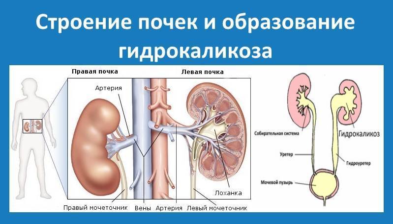 Гидрокаликоз почек у женщин