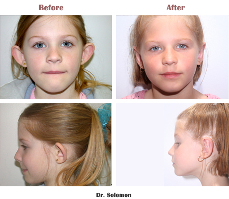 Уши на разной высоте. разные уши у новорожденного ребенка