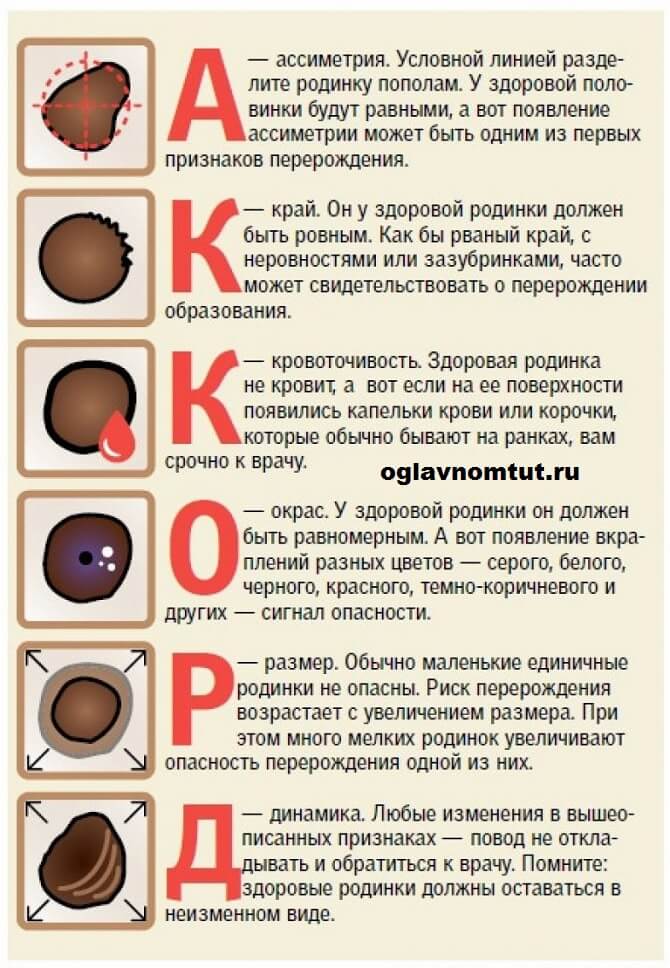 Что делать с родинками у ребенка