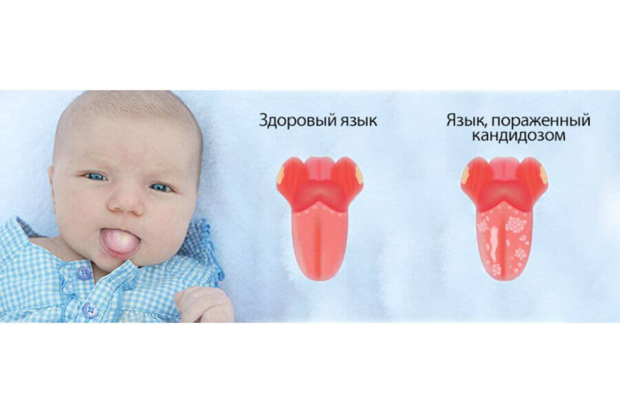 Белый налет на языке у грудничка: что делать