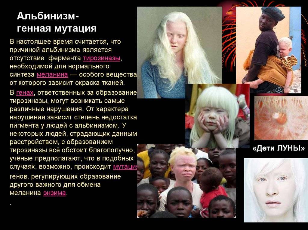 Глазной альбинизм