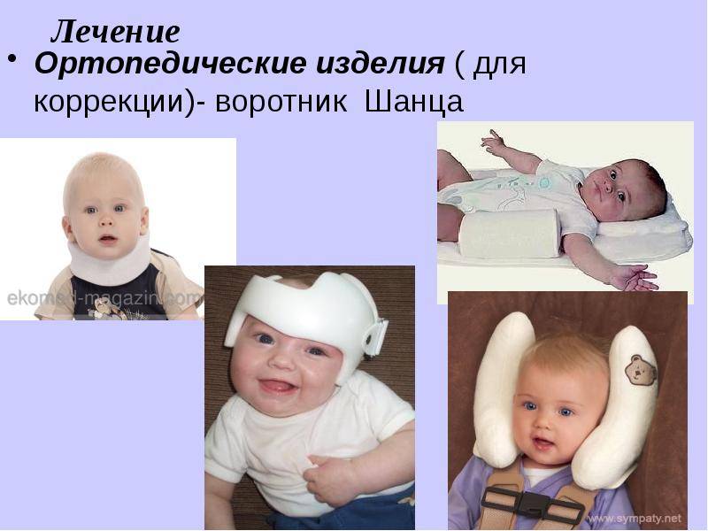 Разновидности кривошеи у младенцев и методы их лечения - владмедицина.ру