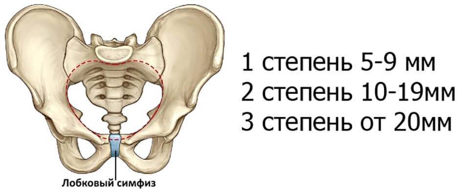 Симфизит при беременности фото