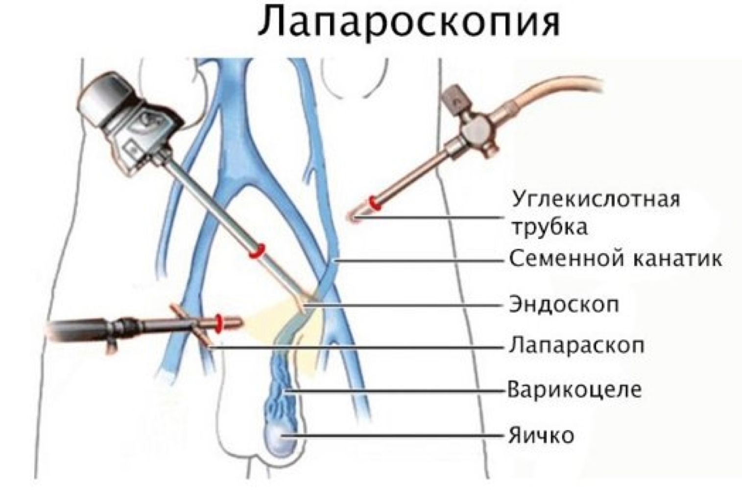 Операция по варикоцеле: все, что нужно знать