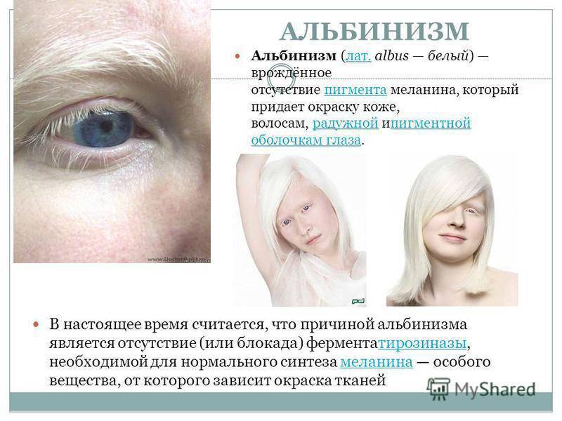 Кто такие люди-альбиносы? почему люди рождаются альбиносами? :: syl.ru