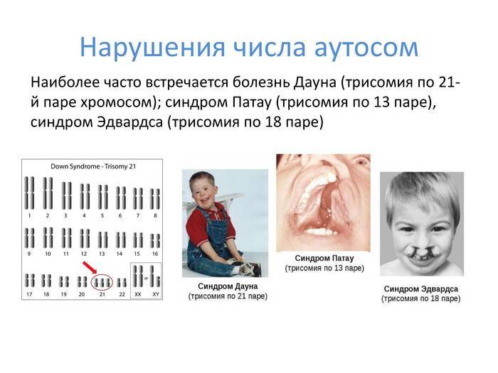 Синдром патау: фото новорожденных, симптомы, лечение, что это такое