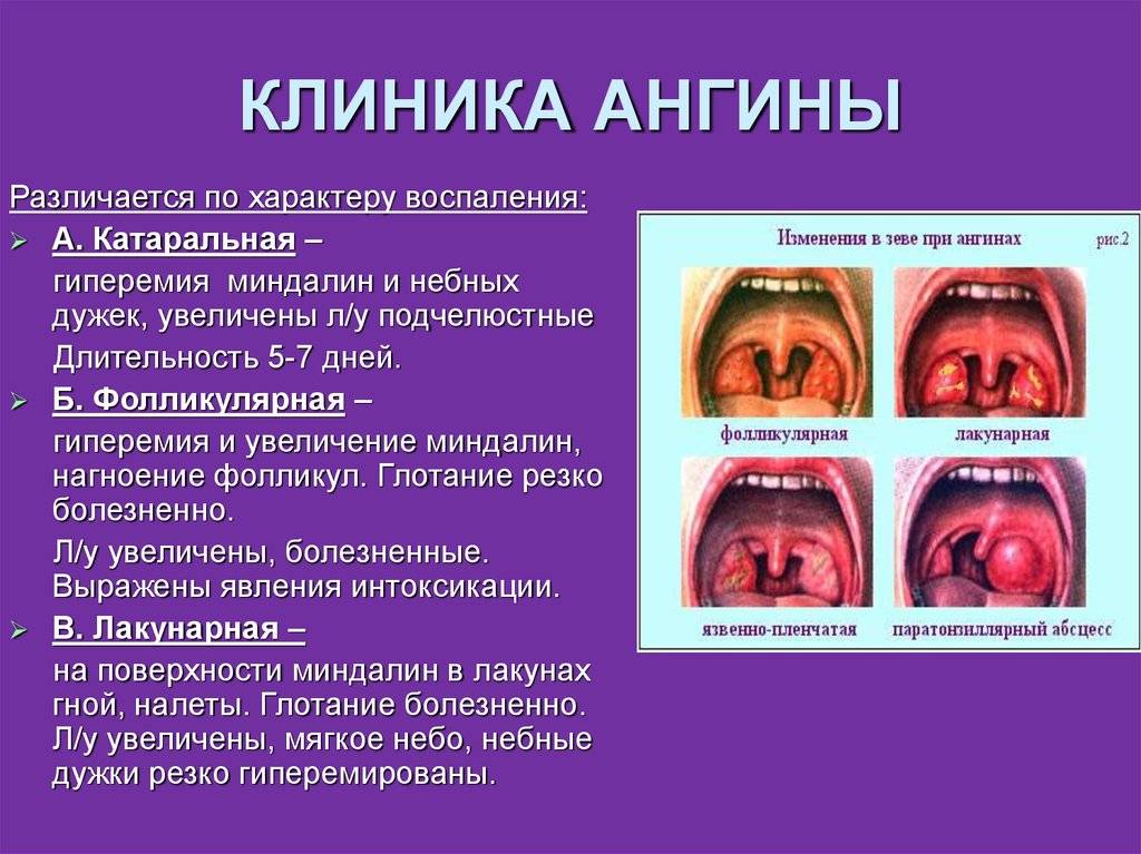 Стрептококк в горле симптомы и лечение | подольская городская детская поликлиника № 3