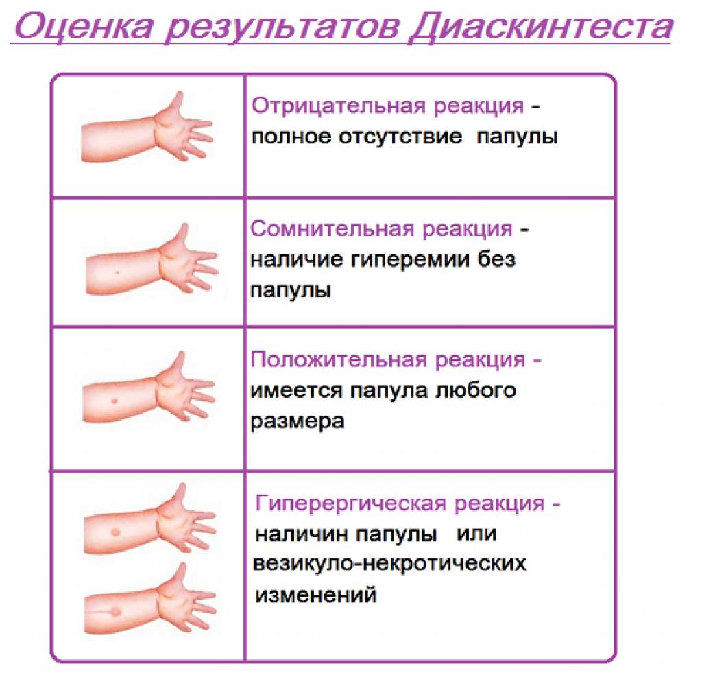Аллерген туберкулезный очищенный (манту) (россия) | университетская клиника