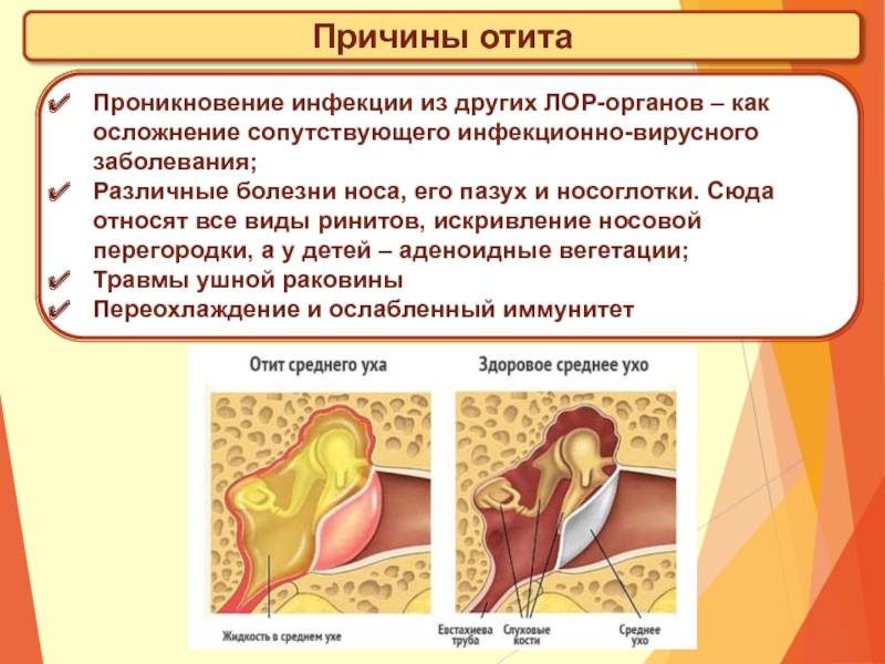Отит уха у взрослого: симптомы и лечение, наружный, внутренний, средний. – эл клиника