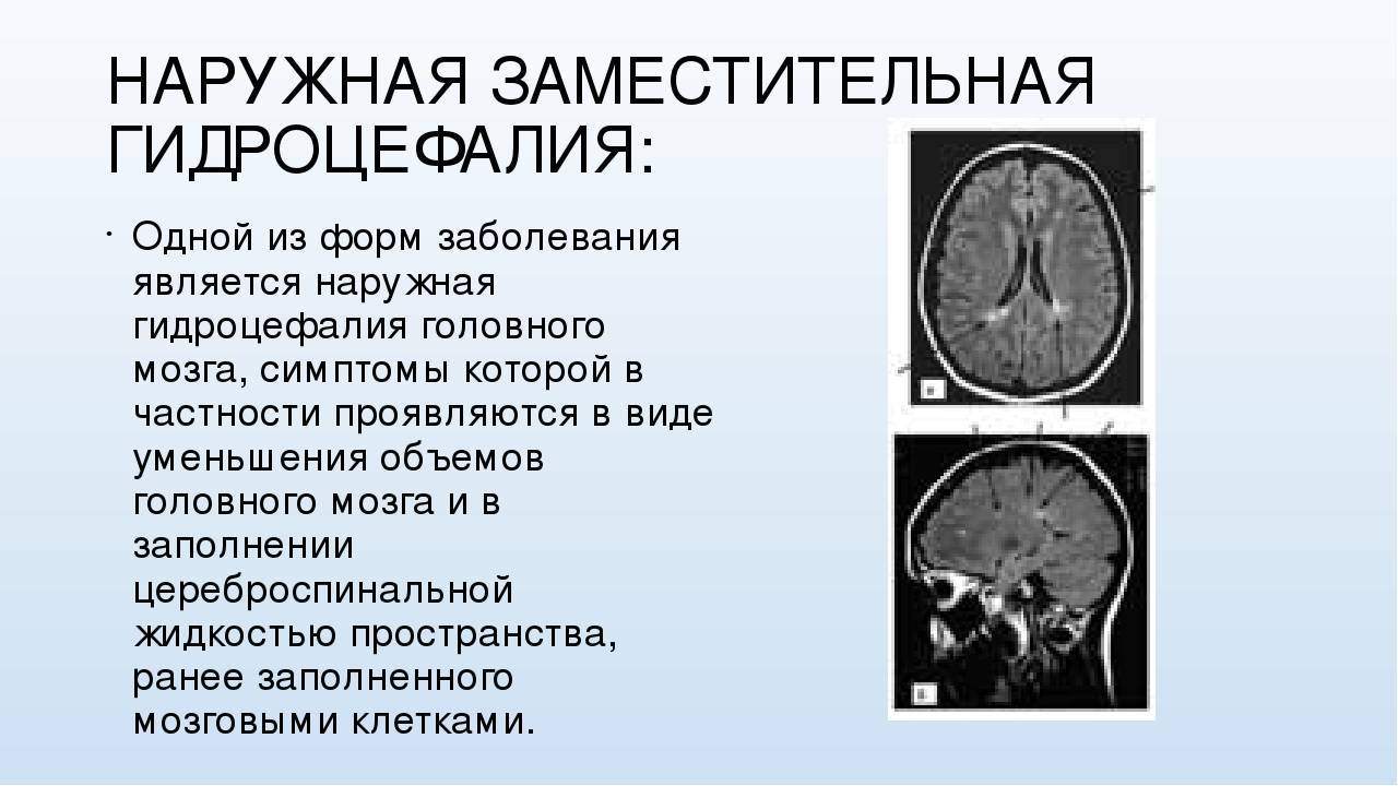 Гидроцефалия головного мозга на мрт  виды, признаки, заключение мрт при гидроцефалии