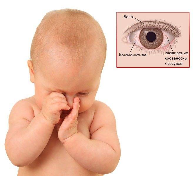 Конъюнктивит у детей - виды, причины, диагностика и лечение | детская офтальмология см-