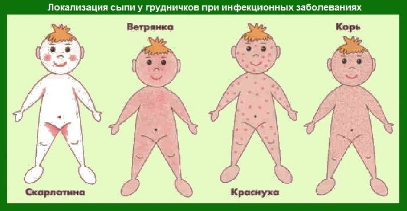 Определяем прыщи в паху у ребенка, лечение и профилактика
определяем прыщи в паху у ребенка, лечение и профилактика