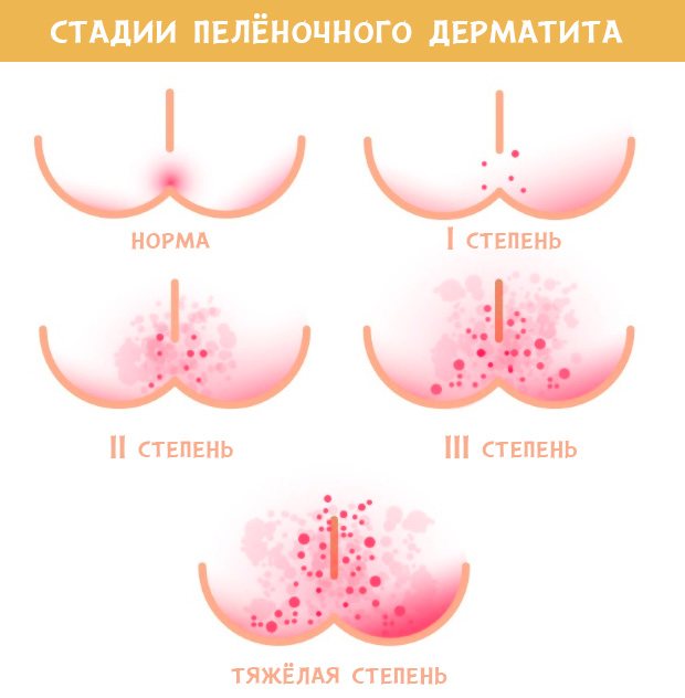 Как вылечить пеленочный дерматит у грудничков