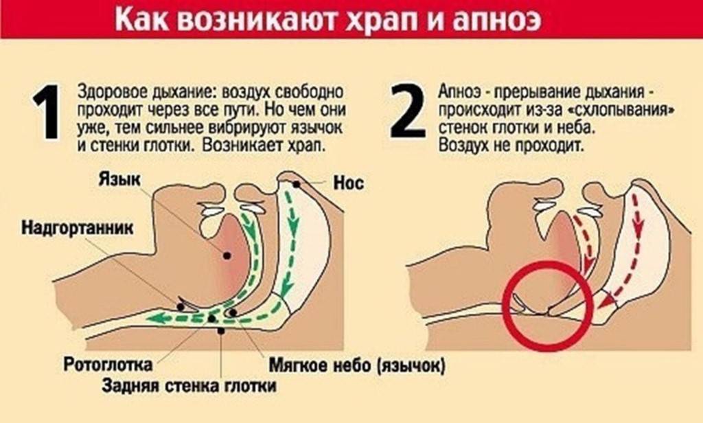Детское апноэ сна