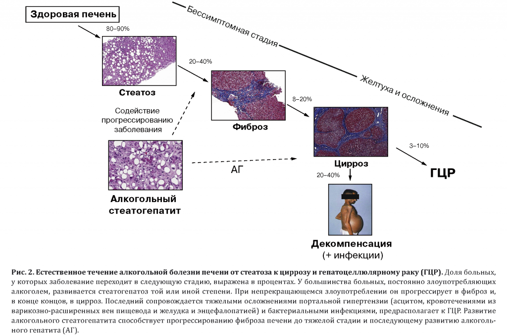 Фиброз печени это. Алкогольная болезнь печени гистология. Алкогольный фиброз печени гистология. Механизмы развития фиброза печени. Степени фиброза печени гистология.