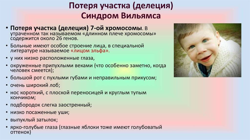 Синдром вильямса: лечение и ноотропная терапия, фото детей с лицом эльфа