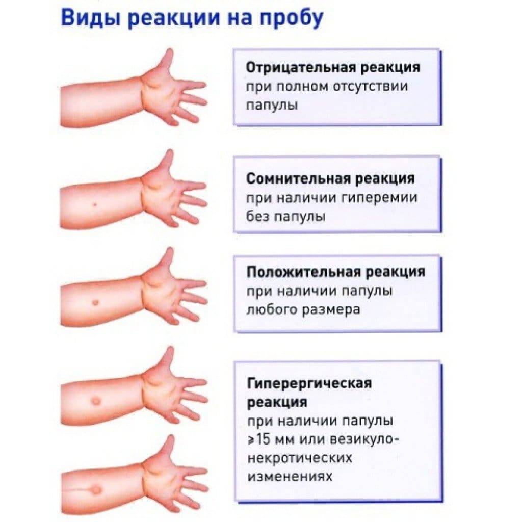 Папула при манту: какой должен быть размер по годам и как определить