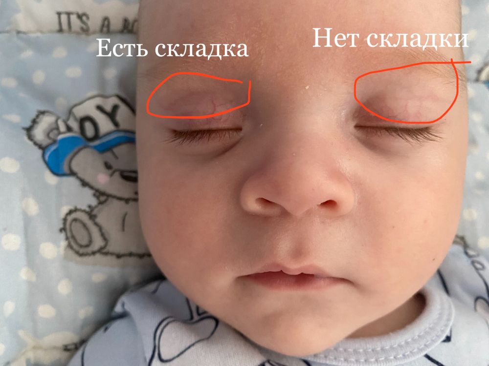 Выделения из глаз у новорожденного (желтые, гнойные) - причины, лечение и профилактика