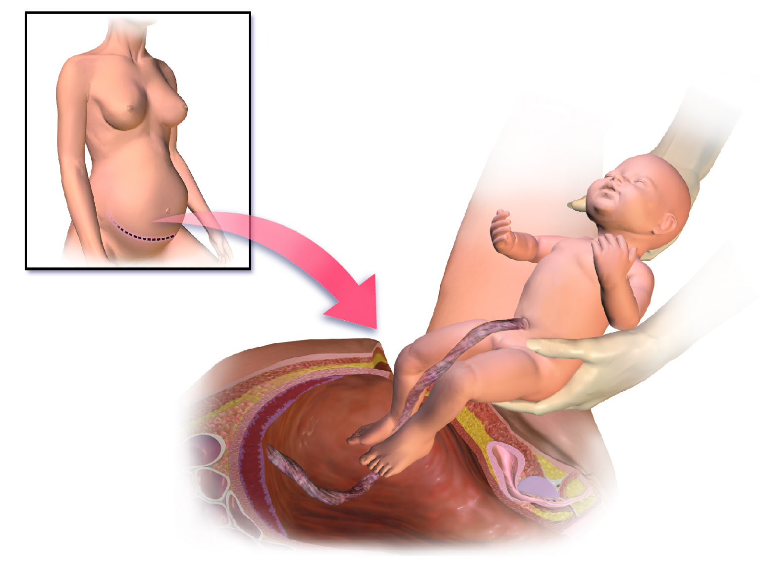 Рождение ребенка кесарево сечение. Родоразрешение кесарево сечение. Разрез после кесарева сечения. Второй беременности после родов