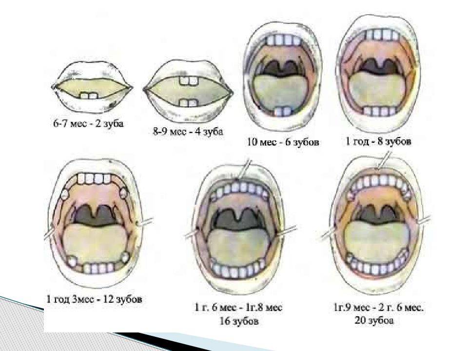 Сколько зубов должно быть у ребенка в 1 год: норма по возрасту и поочередность прорезывания