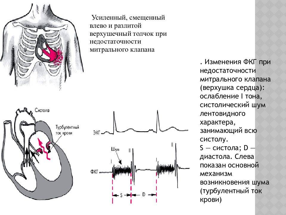 У ребенка шумы в сердце: основные причины, диагностика, подходы к лечению