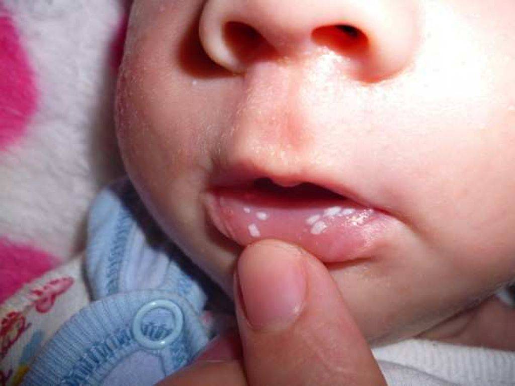 Лечение стоматита у детей: симптомы, виды и профилактика