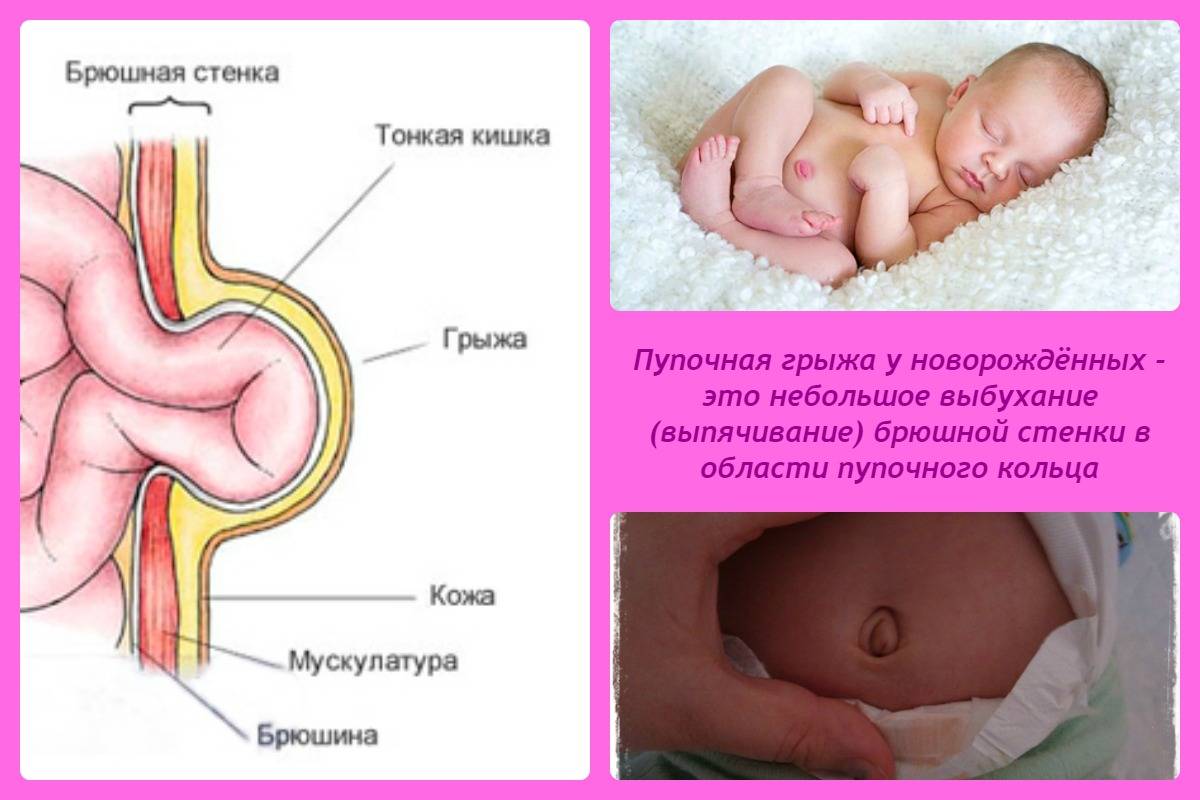 Пупочная грыжа у новорожденных (симптомы и лечение в домашних условиях)