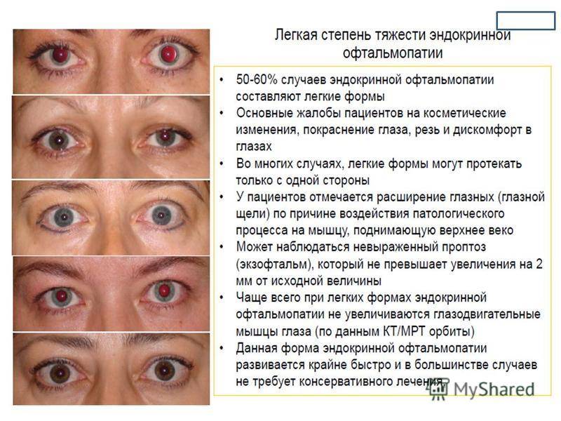 Нистагм - виды, причины, симптомы, методы диагностики и лечения