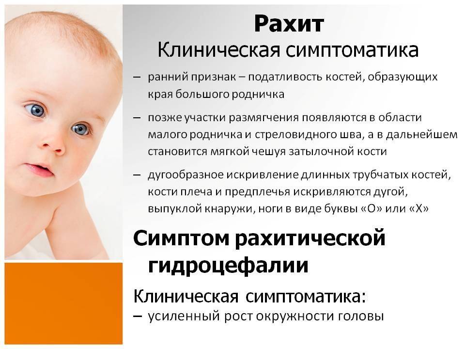 Что нужно знать про рахит | детская городская поликлиника № 7