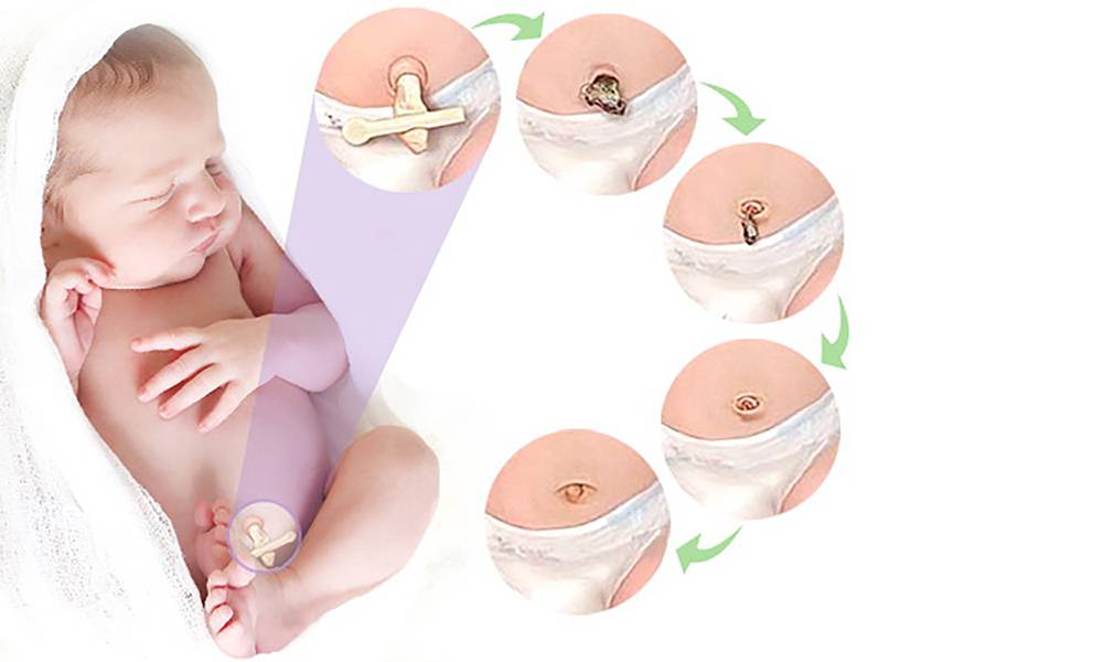 Как обрабатывать пупок новорожденного с прищепкой и когда она отпадает