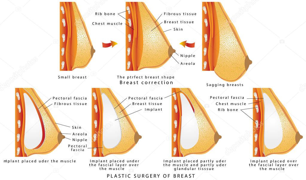 Кормление грудью после установки имплантов: что нужно знать