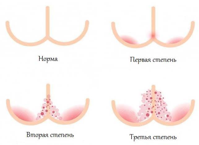 Опрелость | симптомы | диагностика | лечение - docdoc.ru