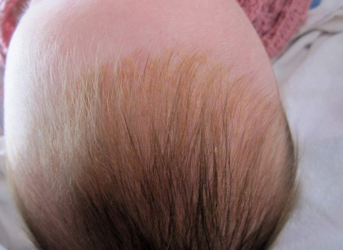 Желтая корочка на ушах у грудничка. уши новорожденного: как правильно ухаживать за ними